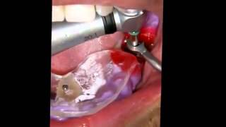 Straumann Guided Implant Surgery [upl. by Hagood731]