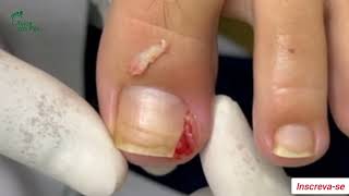 Unhas encravadas 032024 viral ingrowntoenail infectednail podologoleonardovieira [upl. by Adnorhs]