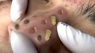 Clean Giant Blackheads on Nose [upl. by Silvestro759]