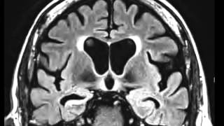 Mesial Temporal Sclerosis [upl. by Naval]