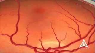 Dry Macular Degeneration [upl. by Nager302]