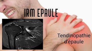 IRM DE L’EPAULE  tendinopathie [upl. by Ramsay494]