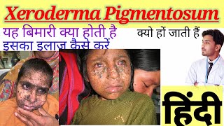 Xeroderma pigmentosum XPwhat is Xeroderma Pigmentosum XP Xeroderma Pigmentosum in Hindi [upl. by Ajax902]