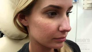 Removing acne scars in 5 minutes [upl. by Greenebaum]