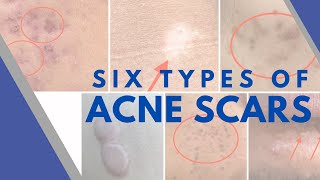 6 Acne Scars Types and their treatment with brand recommendations [upl. by Eyde]