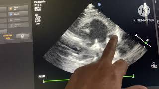 Dilated Coronary Sinus to Persistent LSVC [upl. by Eerb420]