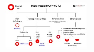 Microcytic anemia  anemia of chronic diseases  sideroblastic anemia Lead poisoning [upl. by Adilen6]