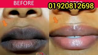 Lip laser treatment before after client review [upl. by Aneej]