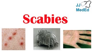 Scabies Skin Condition  What Is It Classic vs Crusted Types Signs amp Symptoms Treatment [upl. by Zoltai]