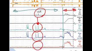 how to interpret cystometry urodynamics [upl. by Bremble]