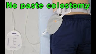 How to use urostomy bag one side [upl. by Ecirtnuahs]