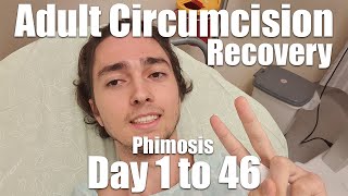 Adult Circumcision Recovery Experience  Day 1 to 46 Phimosis 21yo [upl. by Ecnahoy]