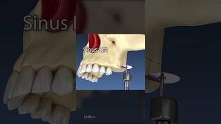 Sinus Lift Surgery 3D Animation [upl. by Jurkoic52]