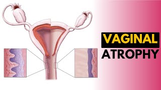 Vaginal Atrophy Causes Signs and Symptoms Diagnosis and Treatment [upl. by Ttoille]