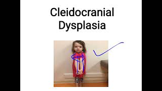 cleidocranial dysplasia [upl. by Adnohrahs333]