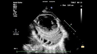 Constrictive pericarditis echocardiography [upl. by Odnolor]