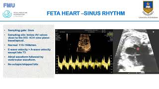 Fetal Heart Examination [upl. by Edylc848]