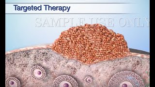 Treatment Options for Ovarian Cancer [upl. by Sonaj]