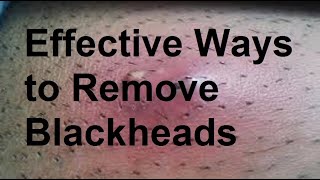 Effective Ways to Remove Blackheads [upl. by Yenhoj803]