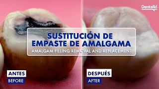 EMPASTE METÁLICO de AMALGAMA  Así se CAMBIA por uno de RESINA PASO a PASO en 4K [upl. by Nadroj59]