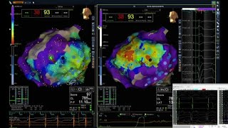 Sistema per migliorare terapia ablativa delle aritmie cardiache [upl. by Alol]