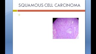 Pathology 762 a Squamous Cell Carcinoma tumor Kangari Keratin pearl SCC epidermal [upl. by Sello]