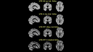 Ultrashortecho time magnetization transfer UTEMT 3D Rosette MRI for brain iron imaging [upl. by Forkey]