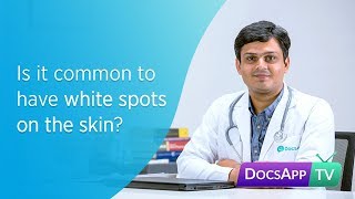 Is it common to have White Spots on the Skin AsktheDoctor [upl. by Adnaral]