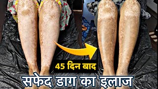 Vitiligo Treatment Full Information Hindi  Vitiligo Micropigmentation  ￼vitiligo Tattoo Cover up [upl. by Aruabea]