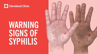 Warning Signs of Syphilis [upl. by Anayd]