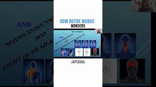 How Botox Works Wonders [upl. by Biancha647]