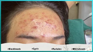 Big Cystic Acne Blackheads Extraction Blackheads amp Milia Whiteheads Removal Pimple Popping [upl. by Peters196]