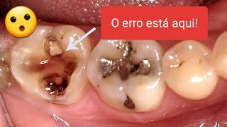 DOR no dente RESTAURADO QUANDO a CULPA é do DENTISTA [upl. by Perusse835]