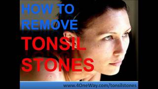 How To Remove Tonsil Stones  Tonsil Stones Treatment [upl. by Ulyram732]