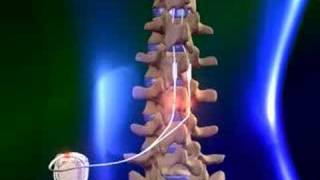 Spinal cord stimulator [upl. by Ing]