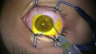 Corneal Collagen Cross Linking for Keratoconus [upl. by Hoang]