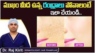 How to Close Open Pores Permanently In Telugu  Pimples amp Open Pores  Celestee Skin amp Hair Clinic [upl. by Ramirol]