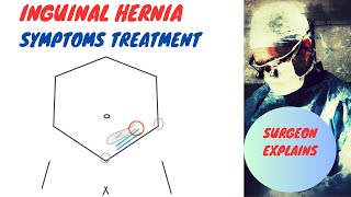 Inguinal Hernia Symptoms and Treatment [upl. by Annahsit]