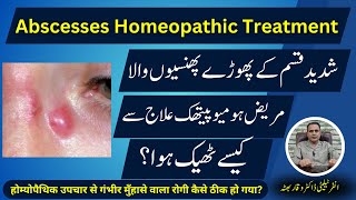 Abscesses پھوڑے پھنسیاں फोड़े Homeopathic Treatment by DR Waqar Bhutta in UrduHindi [upl. by Nodnarg455]