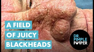 A FIELD OF JUICY BLACKHEADS [upl. by Igig681]