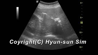 Pneumobilia of bile duct ultrasonography담관 기종 [upl. by Roswald892]