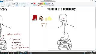 Anaemia The Clinical Picture  Haematinics Deficiencies Part 2  B12 and Folate [upl. by Nyrehtac]