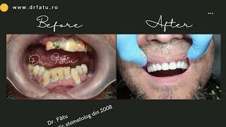 Fast and Fixed implant dentar intro zi  Dr Fătu [upl. by Grail]