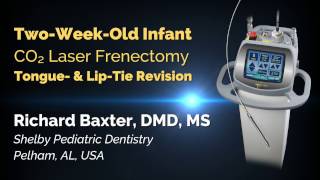 Infant CO2 Laser Frenectomy  Tongue amp LipTie Release  Richard Baxter DMD [upl. by Uwkuhceki166]