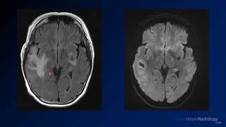 Imaging brain tumors  5  Non glial tumors [upl. by Flynn]