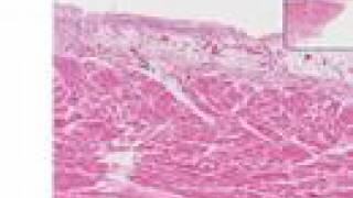 Histopathology HeartAcute fibrinous pericarditis [upl. by Elleoj]