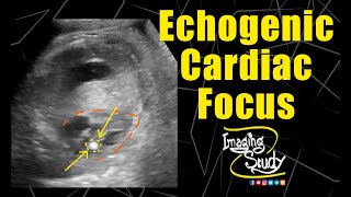 Fetal Echogenic Cardiac Focus  Ultrasound  Anomaly  Case 158 [upl. by Anissa]