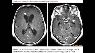 31 Neurosarcoidosis and tuberculous meningitis leptomeningeal perivascular granulomatous [upl. by Naivad]