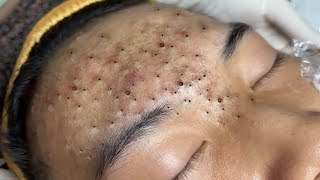 Big Cystic Acne Blackheads Extraction Blackheads amp Milia Whiteheads Removal Pimple Popping  316 [upl. by Siraved]