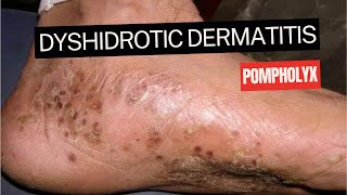 Dyshidrotic Eczema Pompholyx [upl. by Demy]